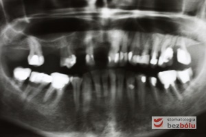 Diagnostyka radiologiczna - ortopantomogram wskazuje zęby nierokujące do usunięcia i liczne wypełnienia do wymiany