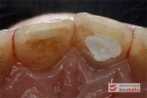 Powierzchnie podniebienne siekaczy centralnych, jedynka lewa zaopatrzona materiałem tymczasowym w trakcie leczenia endodontycznego