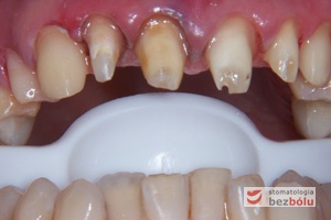 Stan filarów i dziąseł po zdjęciu dotychczasowych koron - zęby opracowano jako filary pod przyszłe protetyczne uzupełnienia pełnoorcelanowe