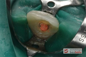 Kanał zęba wypełniony gutaperką z uszczelniaczem typu AH plus metodą termokondensacji ciśnieniowej systemem B i Obturą
