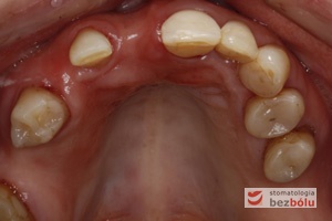 Powierzchnie okluzyjne górnego łuku zębowego - zęby szczęki przygotowane zachowawczo do dobudowy implanto-protetycznej