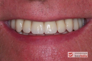 Uśmiech pacjenta po przeprowadzonym leczeniu - "O takie zęby mi chodziło..."