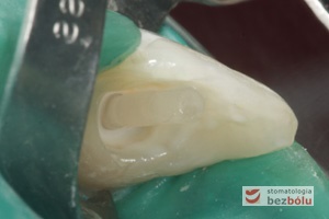 Ząb sieczny z wprowadzonym ćwiekiem z włókna szklanego Fibre Core - widok z boku