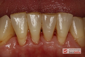 Status dolnego łuku zębowego - mierny stopień zaniku dziąsła- nieliczne wypełnienia przyszyjkowe i okluzyjne