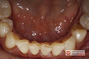 Zęby dolne powierzchnie okluzyjne - brak drugiego przedtrzonowca po stronie prawej - wady zębowe - rotacje i inklinacje