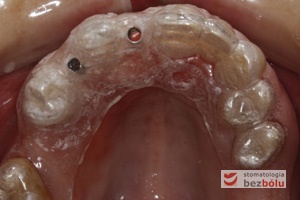 Szablon implantologiczny na zębach szczęki - wyznaczenie właściwej pozycji dla implantów poprzez termoplastyczny nawigator