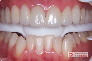 Długoczasowe korony prowizoryczne - etap pośredni - materiał PMMA doskonale imituje naturalny wygląd zębów i wspomaga zarządzanie tkanką miękką.