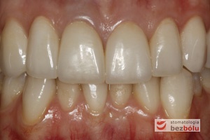 Ostateczne korony pełnoceramiczne w jamie ustnej - zacementowane korony pełnoceramiczne z poszanowaniem tkanki miękkiej i wyrównaną girlandą dziąsłową