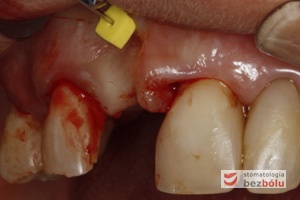 Mapowanie kości - diagnostyka grubości błony śluzowej przy użyciu instrumentu endodontycznego