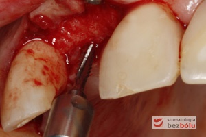 Ustalenie pozycji implantu - wiertło Lindemana wyznacza nachylenie i oś długą dla wprowadzanego implantu