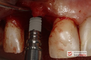Wprowadzenie implantu do łoża - implant Ankylos wprowadzany ręcznie przy użyciu raczety