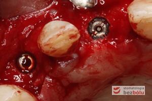 Implanty in situ - widok okluzyjny wprowadzonych wszczepów 1 mm podwyrostkowo