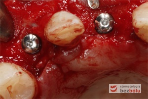 Miniśruby chirurgiczne wprowadzone do implantów - miniśruby zapewniają łatwiejszą identyfikację miejsca wszczepu przy ekspozycji