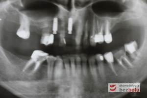 Pozabiegowa kontrola radiologiczna - ocena pozycji wprowadzonych wszczepów i kontrola po leczeniu endodontycznym