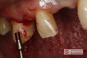 Ekspozycja implantów - wykręcenie śrub zakrywkowych w celu wprowadzenia śrub gojących