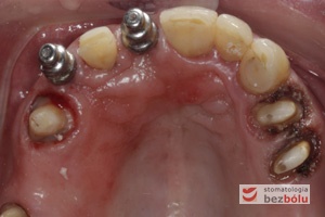 Filary protetyczne przygotowane do pobrania wycisku - transfery wyciskowe typu "bałwanek" przykręcone do implantów - zęby po redukcji dziąsła