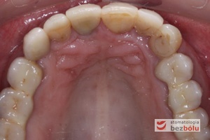 Mosty na zębach własnych i korony na implantach - ceramiczne uzupełnienia braków wprowadzone na filary - widok okluzyjny