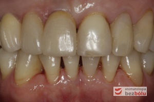 Ostateczna praca protetyczna w ustach pacjentki - korony na implantach - mosty w strefach bocznych - licówka na dwójce górnej prawej