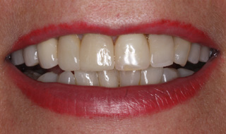Bezcenny uśmiech pacjentki - implanty zębowe