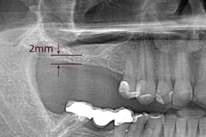 Niewielka ilość kości (2mm) i spneumatyzowana zatoka uniemożliwia wprowadzenie implantu