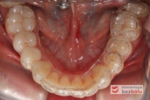 Gotowa nakładka prostująca zęby w jamie ustnej