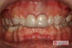 Gotowa szyna repozycjonująca zęby w jamie ustnej