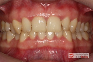 Zwarcie zębów przed leczeniem z wykorzystaniem systemu DAMON