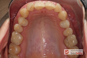 Układ zębów w łuku górnym przed leczeniem