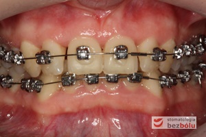 Początkowa faza leczenia, szeregowanie zębów