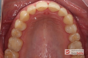 Widok łuku górnego, szczególną uwagę zwraca układ siekaczy bocznych i odrotowanie zębów bocznych