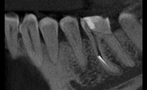 Screen z tomografii wolumetrycznej uwidoczniający kanał korzeniowy wraz z tkwiącym w nim narzędziem endodontycznym (biały kolor) - 3D_capture_small