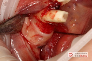 Skrzep fibrynowy w postaci błony umieszczany na wyrostku zębodołowym po implantacji