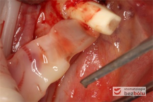 Zwarta i odporna na urazy mechaniczne błona fibrynowa stabilnie ulokowana na wyrostku zębodołowym