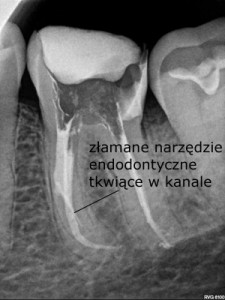 Złamane narzędzie endodontyczne tkwiące w kanale uniemożliwia prawidłową dezynfekcję systemu kanałowego - Sięgnąć gdzie wzrok nie sięga