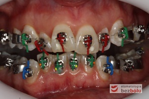 II faza leczenia - założenie aparatu DAMON ze zróżnicowanym torkiem dla poszczególnych zębów