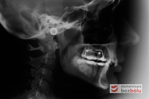Zdjęcie radiologiczne cefalometryczne wykonane przed leczeniem ortodontycznym