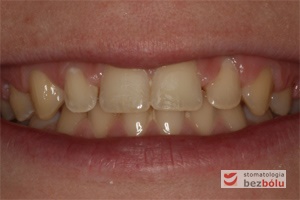 Uśmiech pacjentki przed leczeniem - leczenie ortodontyczne jako przygotowanie protetyczne