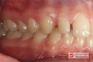 Zęby w zwarciu po stronie prawej przed leczeniem