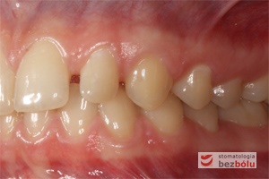 Zęby w zwarciu po stronie lewej przed leczeniem
