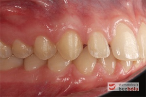 Zgryz pacjentki po zakończonym leczeniu ortodontycznym - strona prawa