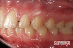 Zgryz pacjentki po zakończonym leczeniu ortodontycznym - strona lewa