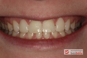 Uśmiech pacjentki po zakończonym leczeniu ortodontyczno-protetycznym