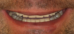 Zaakceptowany przez pacjenta projekt nowego uśmiechu -  DSD - Digital Smile Design