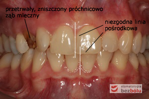 Status zębowy wyjściowy Status zębowy wyjściowy