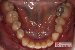 Łuk zębowy dolny - liczne wady zębowe (rotacje, inklinacje)