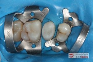 Zęby trzonowe i przedtrzonowe w trakcie leczenia