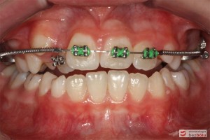 Widok zębów w trakcie leczenia
