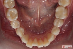 Żuchwa - stłoczenia w rejonie siekaczy, ujemny tork na zębach trzonowych po stronie lewej
