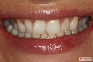 Diagnostyka – nieregularna linia dziąsła, proporcje zębów ~85%