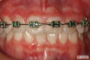 Faza końcowa leczenia Faza końcowa leczenia